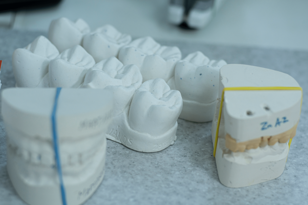 Le differenze tra capsule e faccette dentali