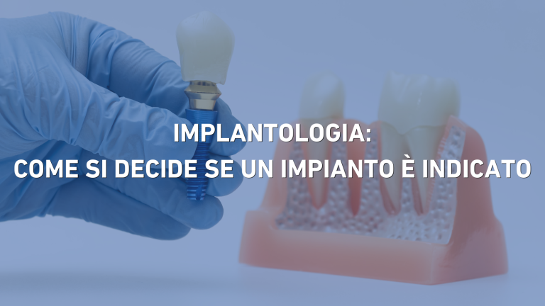 implantologia come si decide se un impianto è indicato