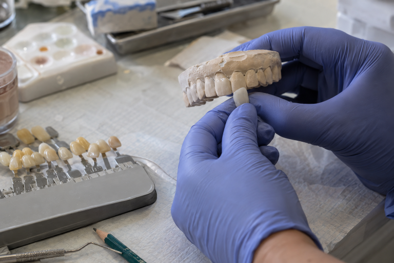 faccette dentali in ceramica