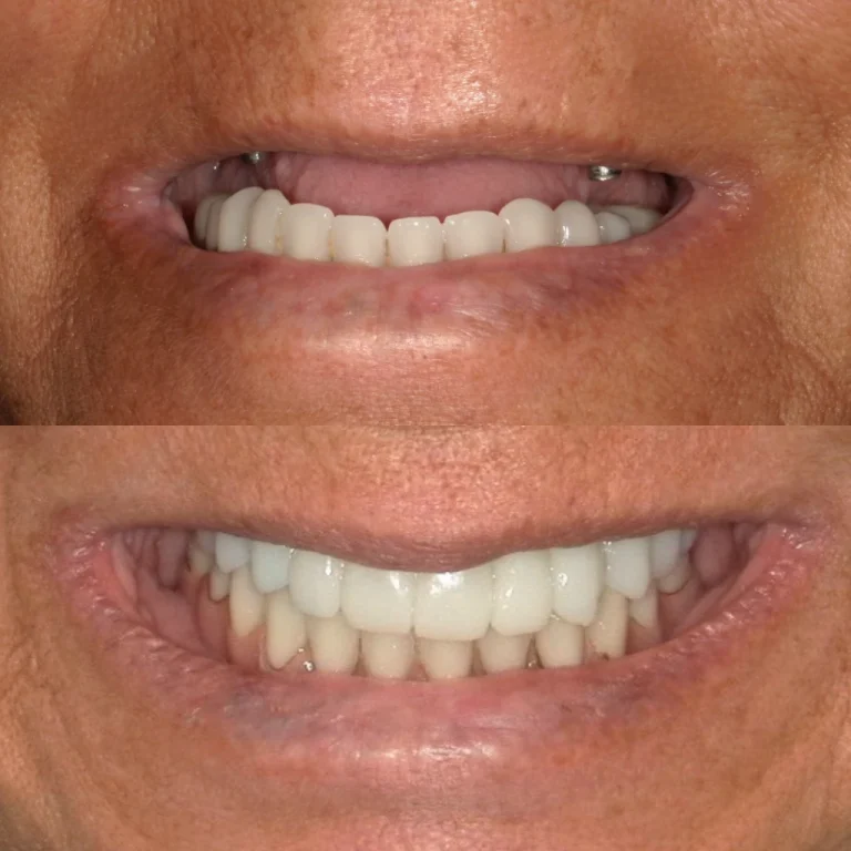 Confronto fotografico del sorriso in due immagini